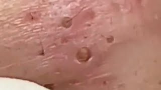 Blackheads amp Whiteheads Satisfying Removal 0105 [upl. by Ellenrad]