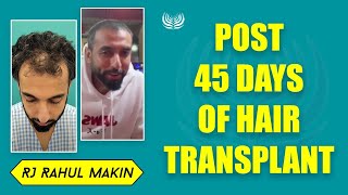 RJ Rahul Makins Post 45 Days Hair Transplant Review  Medlinks  Best Hair Transplant Clinic [upl. by Grizel]