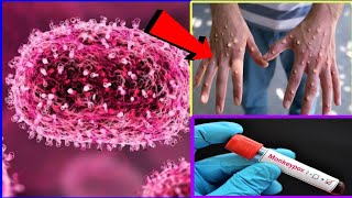 🚨 New Global Health Emergency What is Mpox 🌍 Outbreaks amp Virus Spread Explained Monkey pox [upl. by Alyce451]