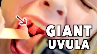 GIANT UVULA Bad Throat Infection  Dr Paul [upl. by Esilehc]