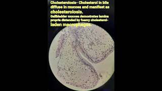 Cholesterolosisfoamy macrophagesgallbladderintracellular accumulationsH andEPathology [upl. by Koralie]