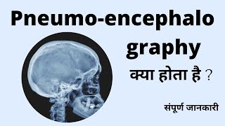 Pneumoencephalography Radiological procedure Air study PEG Study क्या होता है  संपूर्ण जानकारी [upl. by Rambort]