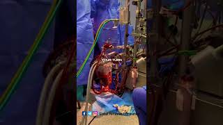 Perfusion aspects by a clinical Perfusionist perfusion nurse [upl. by Abe]