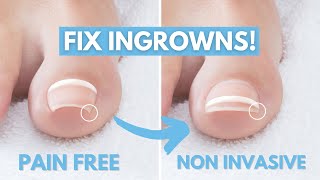 Treat Ingrown Toenails with Onyfix [upl. by Ordnagela]