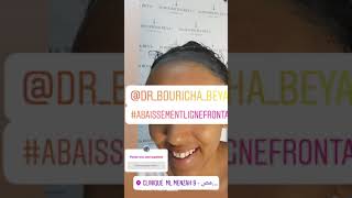 Greffe de Cheveux femme  Dr Bouricha Beya [upl. by Sirehc]