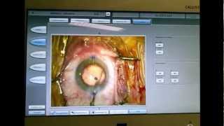 CALLISTO Eye system  Chirurgie de la cataracte Dr Coullet Montpellier [upl. by Haral545]