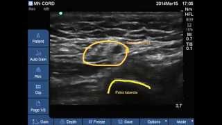 UltrasoundSpermatic cord for cord block [upl. by Atiram]