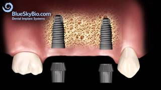 Patient Treatment Videos Implant Bridge [upl. by Rombert]