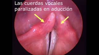 PARÁLISIS BILATERAL DE CUERDAS VOCALES  BILATERAL VOCAL FOLD PALSY [upl. by Ogden]