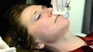 Dermapen Treatment by Cosmetic Laser MD [upl. by Lumbye864]