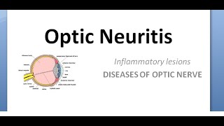 Ophthalmology Optic neuritis Papillitis NeuroRetinitis RetroBulbar phosphenes uhthoff pulfrich [upl. by Ivonne]