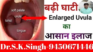 Uvula Swollen SymptomsUvulitis TreatmentGhati Badhane Par Kya kare [upl. by Josselyn786]