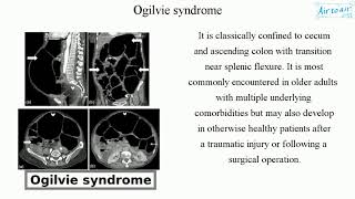 Ogilvie syndrome [upl. by Alika281]