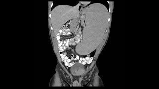 Hepatomegaly amp splenomegaly Hepatosplenomegaly by profMarwa AlEmam [upl. by Astra]