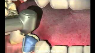 Crowns  Procedure for your new crown at Dental Reflections [upl. by Dafodil]