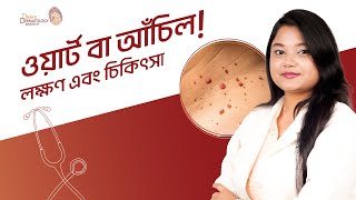 Wart । Dr Zakia Tasnim  Dhaka Dermatology Institute [upl. by Maharva]