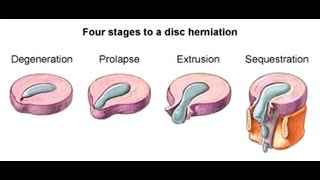 Physiotherapy for Intervertebral Disc prolapse StayHome and study WithMe [upl. by Brendin]