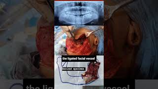 Case of Odontogenic keratocyst  OKC  Cyst of jaw  cystic lesion of jaw  Mandible Ressection [upl. by Cote]