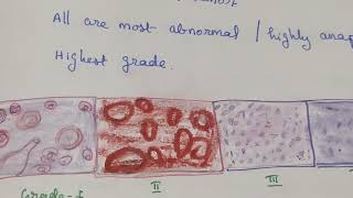 Grading and Staging of Cancer [upl. by Slyke]