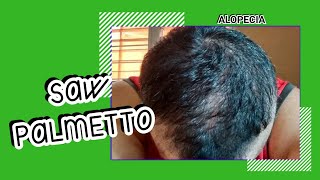 2 Meses con Saw Palmetto  Shedding  Alopecia [upl. by Anawal]