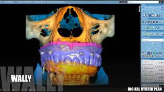 Romexis edentulous guide workflow [upl. by Ellierim]