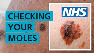 How do I check if my mole is skin cancer  NHS [upl. by Shawna]