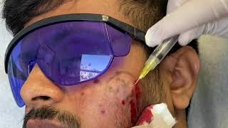 Subcision for Acne Scars [upl. by Airbmac]