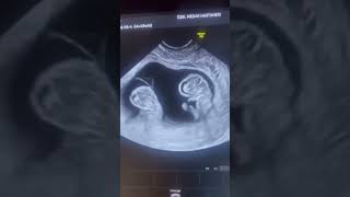 Ultrasound scan In Twins [upl. by Callean804]