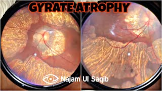 Retinochoroidal Gyrate Atrophy With Myopia [upl. by Shirlee221]