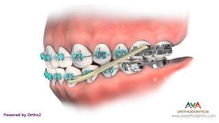 Orthodontics Treatment for Underbite or Crossbite  Rubber Bands [upl. by Yortal]