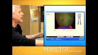 Spectra Caries Detection Aid Patient Education Video [upl. by Dranoel830]