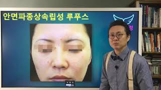 안면파종상 속립성 루푸스 Lupus Miliaris Disseminatus FacieiLMDF [upl. by Ahselak]