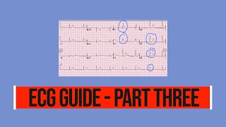 MORE ABNORMAL ECGs Abnormal ECG interpretation guide PART THREE [upl. by Yhprum]