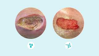 How to assess wound exudate [upl. by Thaddaus]