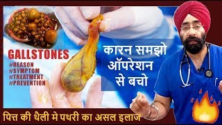 Rx GALLSTONE 1 Hindi पित्त की थैली मे पथरी का कारन समझो ऑपरेशन से बचो ENG SUBTITLES [upl. by Meingoldas536]