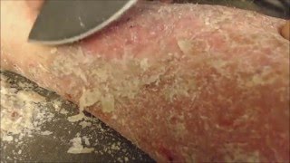 Flakey Hweef Wellington  Psoriasis flakes pick scrape [upl. by Aymik910]