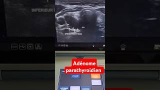 Échographie cervicale adénome parathyroidien inférieur droit tumeur bénigne Scintigraphie adénome [upl. by Ruscio]