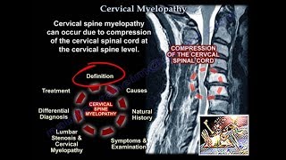 Cervical Myelopathy  Everything You Need To Know  Dr Nabil Ebraheim [upl. by Ariday]