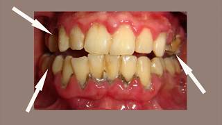 Periodontitis Treatment  Miracle Cure of Gum Disease and Periodontitis [upl. by Alyek748]