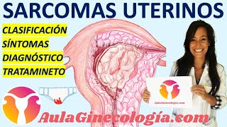 SARCOMAS UTERINOS TIPOS SÍNTOMAS DIAGNÓSTICO TRATAMIENETO  Ginecología y Obstetricia [upl. by Eldoria]