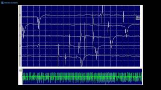 Kimura amp Kohara F18 Transition of positive sharp waves to fibrillation potentials [upl. by Grunenwald]