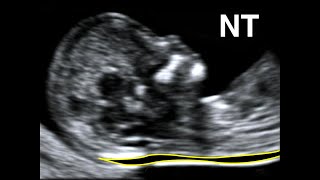 How to perform Nuchal Translucency Scan [upl. by Winston497]