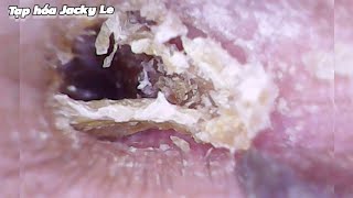 Ear Wax Removal 196 Dry and hard earwax makes his ears always painful  Ear Cleaning ASMR [upl. by Lengel435]