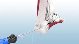 Haglunds Excision and Achilles Reconstruction Using the CuffLink™ System  CONMED Animation [upl. by Htebesile]