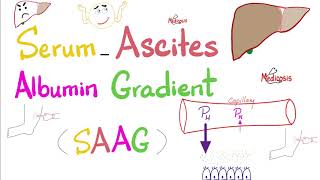 Serum Ascites Albumin Gradient SAAG  Peritoneal Effusion  Lab 🧪 [upl. by Drusy997]