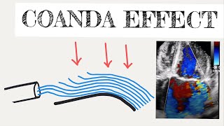 Coanda effect in cardiology [upl. by Kirit]