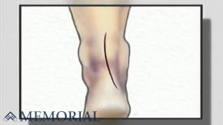 Achilles Tendon Repair Surgery [upl. by Hsekar]