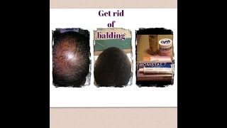 GROW HAIR FAST amp Get RID Of BALD SPOTS Using MONISTAT 7 [upl. by Nuris717]