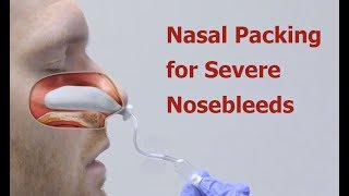 Nasal Packing for Severe Nosebleeds [upl. by Avilla206]