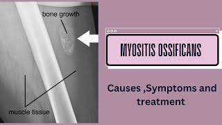 Myositis ossificans [upl. by Zakaria519]